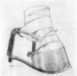Fig. 28&mdash;Showing the Roberts brace in operation.
