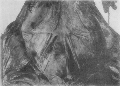 Fig. 49&mdash;Illustrative of thrombosis of the aorta,
iliacs and branches. Photo by Dr. L.A. Merillat.