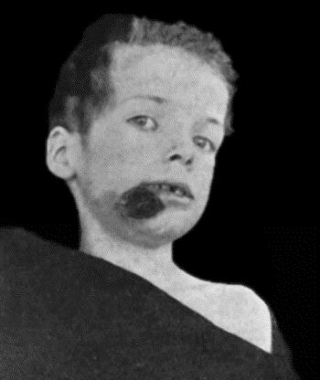 Fig. 23.&mdash;Cancrum oris.  (From a photograph lent by Sir George T. Beatson.)