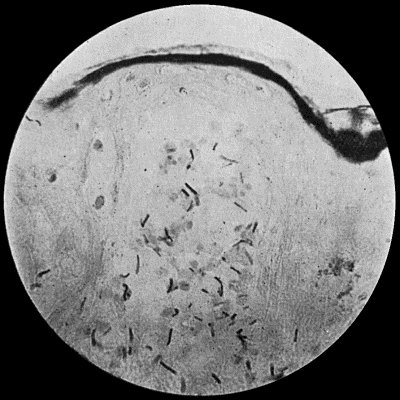 Fig. 27.&mdash;Bacillus of Anthrax in section of skin, from a case of malignant pustule; shows vesicle containing bacilli. &times; 400 diam. Gram's stain.