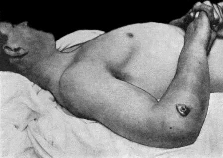Fig. 28.&mdash;Malignant Pustule, third day after infection with Anthrax, showing great œdema of upper extremity and pectoral region (cf. Fig. 29).