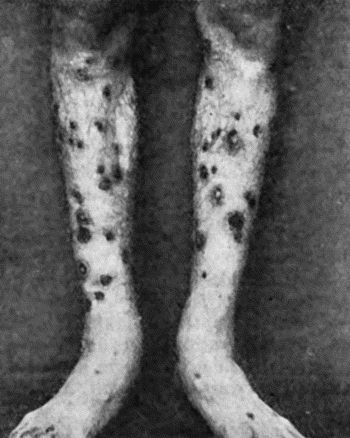 Fig. 39.&mdash;Syphilitic Rupia, showing the limpet-shaped crusts or scabs.