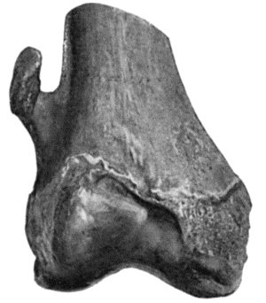 Fig. 52.&mdash;Cancellous Osteoma of lower end of Femur.