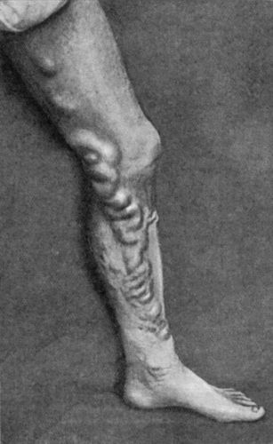 Fig. 67.&mdash;Extensive Varix of Internal Saphena System on Left Leg, of many years' standing.