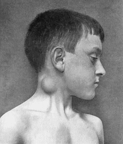 Fig. 77.&mdash;Tuberculous Cervical Gland with abscess formation in subcutaneous cellular tissue, in a boy &aelig;t.&nbsp;10.