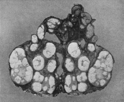 Fig. 78.&mdash;Mass of Tuberculous Glands removed from Axilla (cf. Fig. 79).