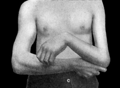 Fig. 90.&mdash;Drop-wrist following Fracture of Shaft of Humerus.