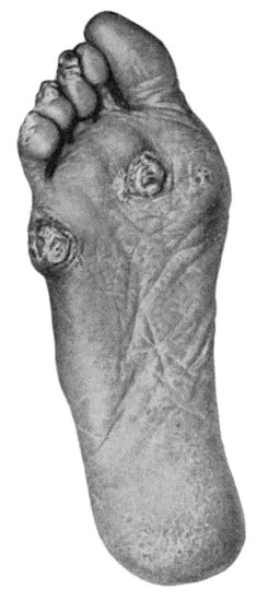 Fig. 93.&mdash;Callosities and Corns on the Sole and Plantar Aspect of the Toes in a woman who was also the subject of flat-foot.