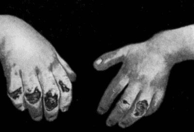 Fig. 94.&mdash;Ulcerated Chilblains on Fingers of a Child.