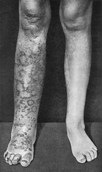 Fig. 96.&mdash;Tuberculous Elephantiasis in a woman &aelig;t.&nbsp;35.