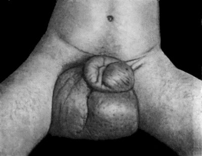 Fig. 98.&mdash;Elephantiasis of Penis and Scrotum in native of Demerara. (Mr. Annandale's case.)