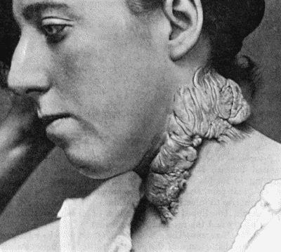 Fig. 106.&mdash;Recurrent Keloid in scar left by operation for tuberculous glands in a girl &aelig;t.&nbsp;7.