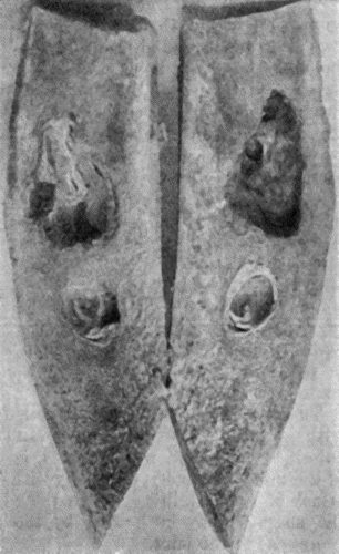Fig. 120.&mdash;Segment of Tibia resected for Brodie's Abscess. The specimen shows two separate abscesses in the centre of the shaft, the lower one quiescent, the upper one active and increasing in size.