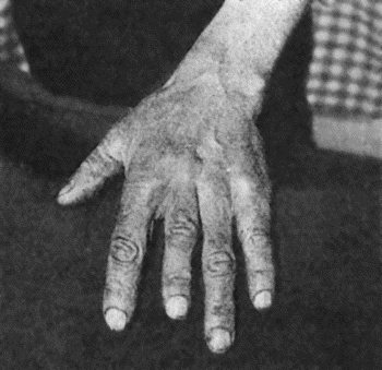 Fig. 129.&mdash;Shortening of Middle Finger of Adult, the result of Tuberculous Dactylitis in childhood.