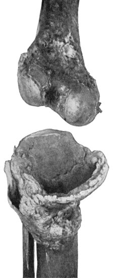 Fig. 162.&mdash;Bones of Knee-joint in advanced stage of Charcot's Disease. The medial part of the head of the tibia has disappeared.  (Anatomical Museum, University of Edinburgh).
