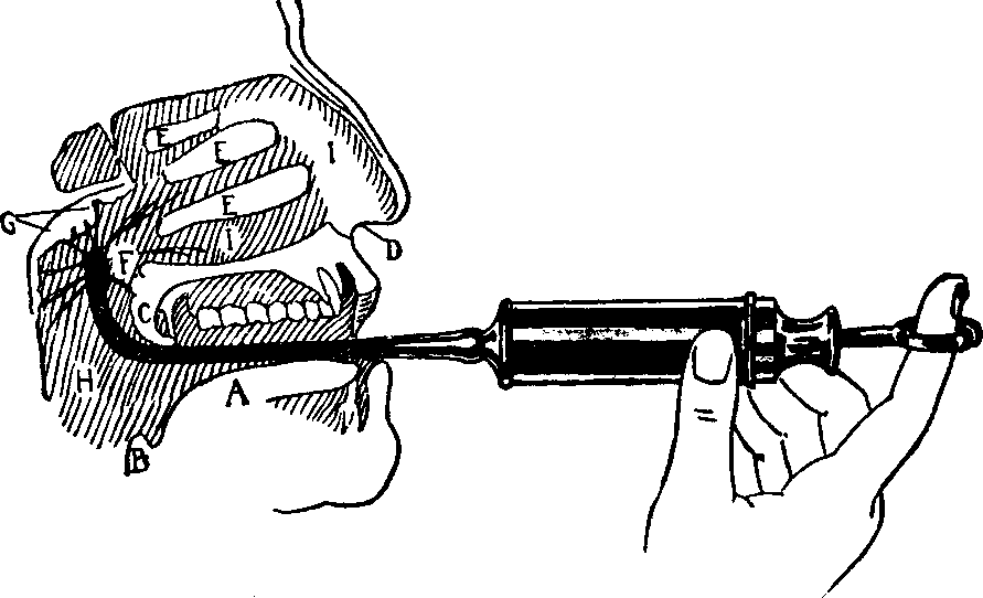 Illustration:
Fig. 16. Use of the Post-nasal Syringe in the treatment of Post-nasal
Catarrh.