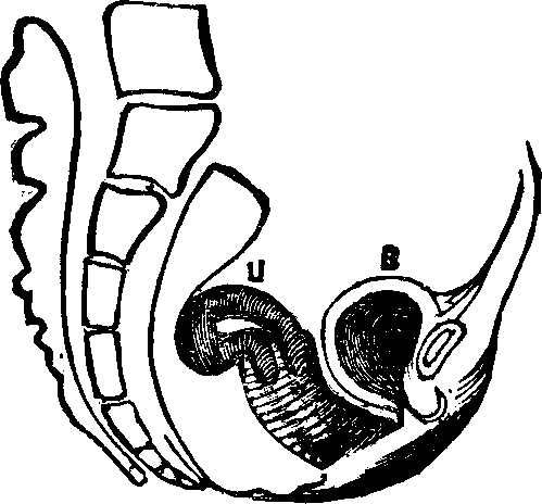 Illustration:
Fig. 12. Retroflexion, U, Uterus (Womb), B, Bladder.