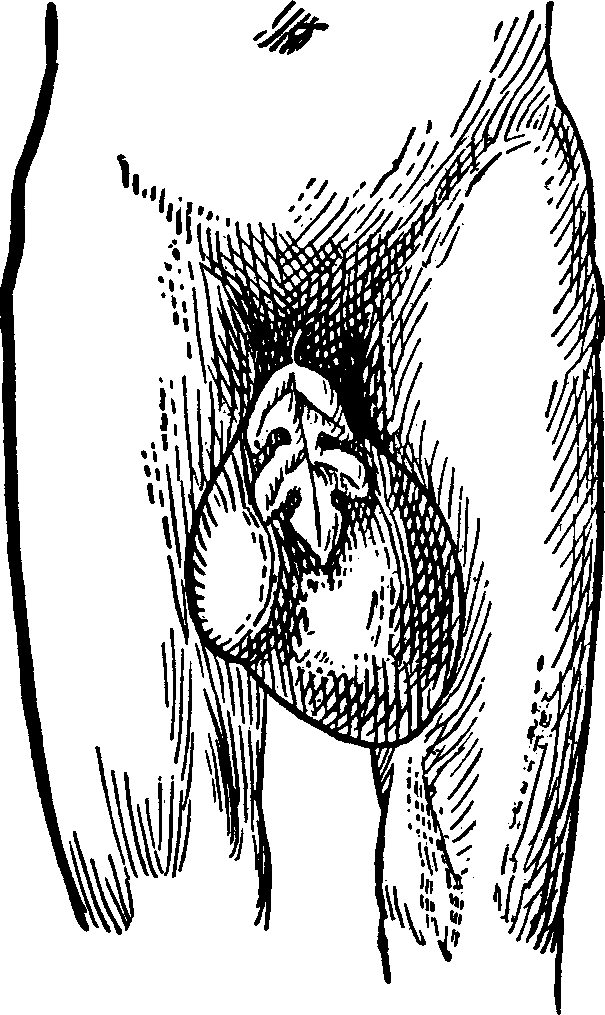 Illustration:
Fig. 4. The above cut fairly illustrates a case of Double Inguinal Hernia,
complicated with Hydrocele, cured at the Invalids' Hotel and Surgical
Institute.