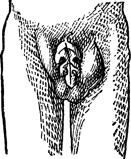Illustration:
Fig. 5.  This figure illustrates a Double Inguinal Hernia