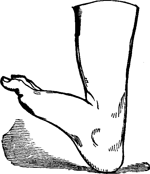 Illustration:
Fig. 11. Talipes Calcaneus.