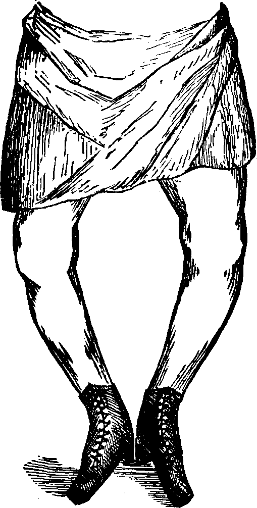 Illustration:
Fig. 14. Bow-legs.