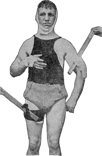 This shows pressure applied by tourniquet (also called Spanish
windlass) instead of the hand and by direct pressure of the First Aid
Packet