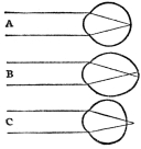 EYE LENS&mdash;NORMAL AND DEFECTIVE

A, normal eye; B, myopic eye; C, hyperopic eye (From Martin’s
“Human Body”)
