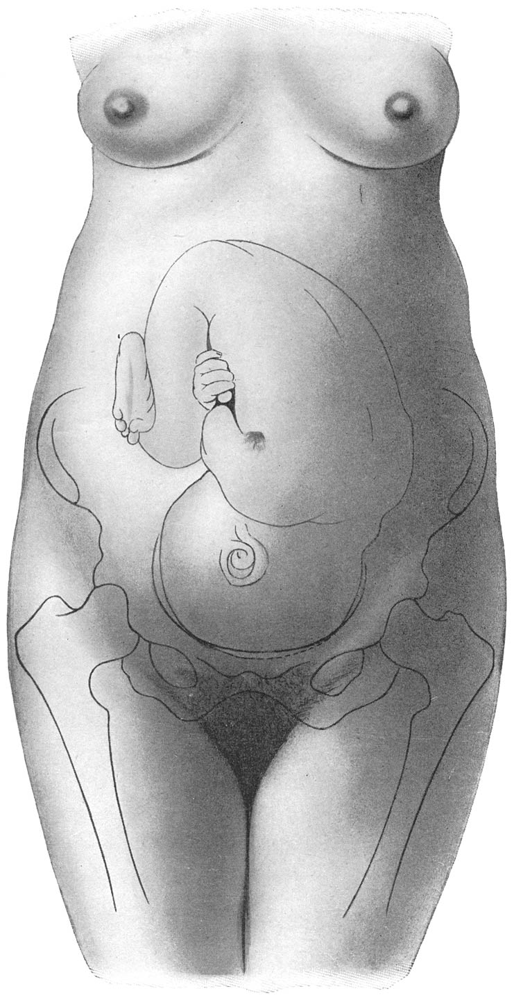 Ligging van het kind in den buik der zwangere vrouw, aan het einde der zwangerschap, met aanduiding van het beenige bekken.